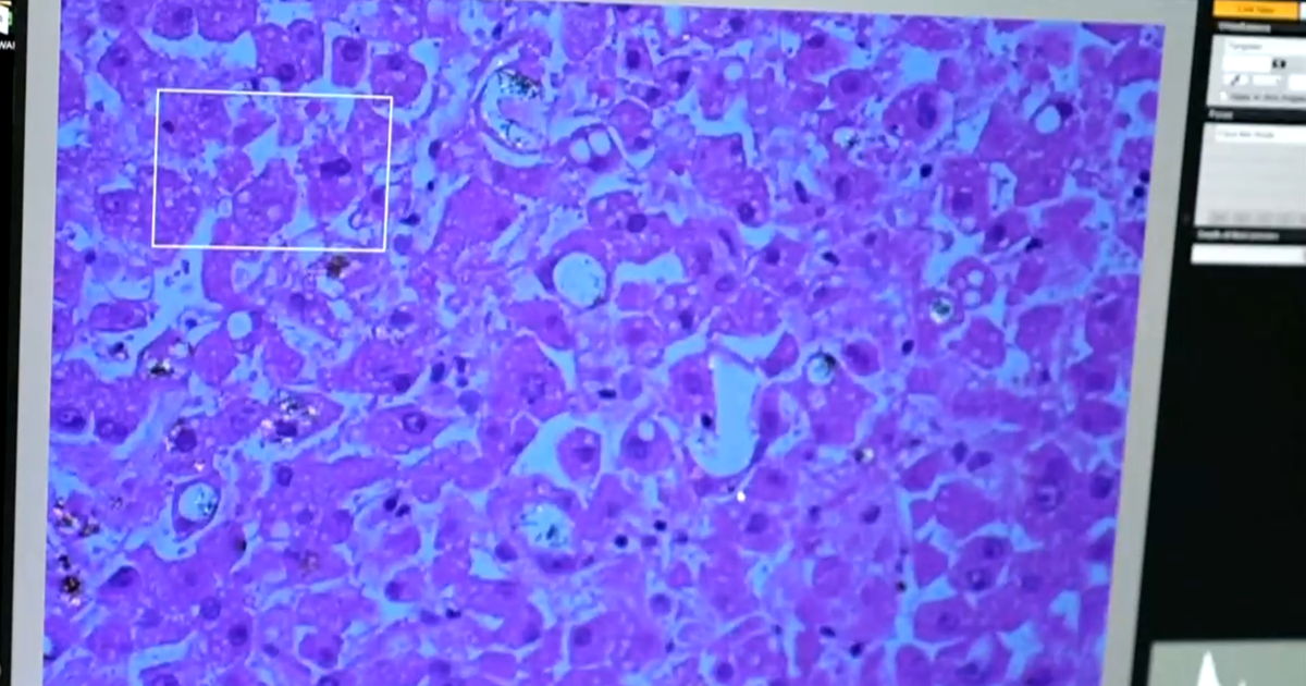 How nanoplastics may be impacting our long-term health - CBS News