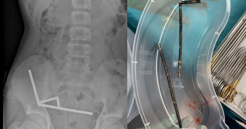 Surgeons remove dozens of magnets from teen's stomach - CBS News