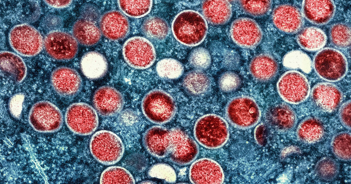 Mpox strain that may be more severe appears to spread locally in U.S. for first time - CBS News