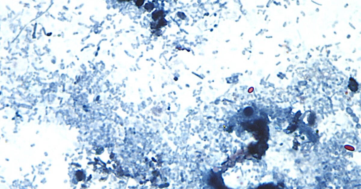 Cyclospora cases have been reported in several states. What to know about the diarrhea-causing parasite. - CBS News